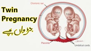 Twin Pregnancy UrduHindi [upl. by Earised48]