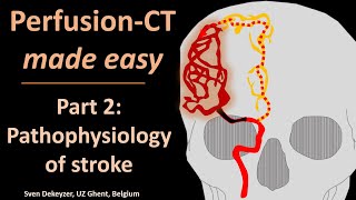 Perfusion CT made easy  part 2  pathophysiology of acute ischemic stroke [upl. by Publea]