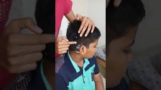 Introduction of cochlear implants [upl. by Gahl]