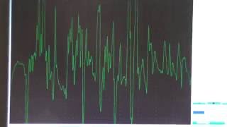 Myopathy EMG changes explained [upl. by Ayikaz]