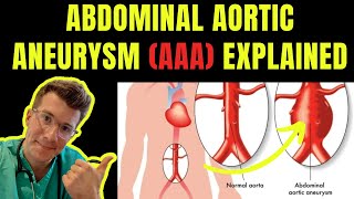 Doctor explains ABDOMINAL AORTIC ANEURYSM AAA  Symptoms risk factors treatment screening [upl. by Keen267]