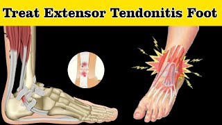 How to Treat Extensor Tendonitis Foot  Extensor Tendonitis Foot Treatment [upl. by Rebma]