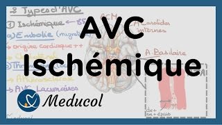 AVC ischémique causes embolie cérébrale AVC thrombose et AVC jonctionnel [upl. by Meuser]