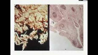 Histopathology JointRheumatoid arthritis [upl. by Ffej]