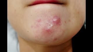 How to get rid of pimples under the skin I 2 Natural Home Remedies that works all the time [upl. by Erwin]