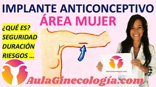 IMPLANTE ANTICONCEPTIVO ¿QUÉ ES SEGURIDAD DURACIÓN RIESGOS  Ginecología y Obstetricia [upl. by Ynar]