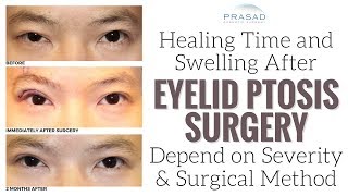 Factors that Affect Healing Time and Temporary Swelling of Eyelid Ptosis Surgery [upl. by Bowyer]