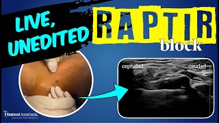 RAPTIR block start to finish Retroclavicular Approach to the Infraclavicular Region [upl. by Nate]