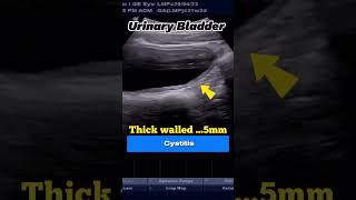 Ultrasound Cystitis of 21yrs Boy with Residual Urine [upl. by Mharg464]