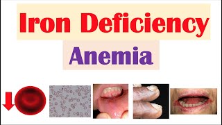 IronDeficiency Anemia Overview  Causes Pathophysiology Signs amp Symptoms Diagnosis Treatment [upl. by Farlay]