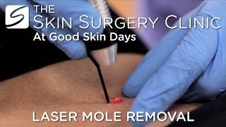 Laser Mole Removal  Watch the Procedure [upl. by Raynata]