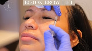 Botox Before and After Eyebrow Lift [upl. by Akemot]