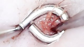 Eruptive vellus hair cyst  Nov 16 video [upl. by Eiramaliehs385]