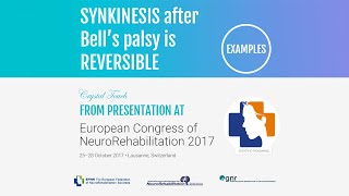 Synkinesis is reversible Examples From presentation on ECNR2017 Lausanne Switzerland [upl. by Dirfliw]