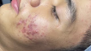 ACNE TREATMENT VU QUYNH MI  Perennial Blackheads On Boy Face 2024FULL [upl. by Htinek747]