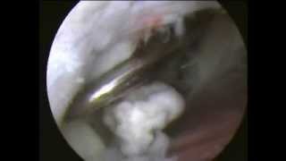 ELBOW ARTHROSCOPY loose body removal  Chondroplasty [upl. by Awe]