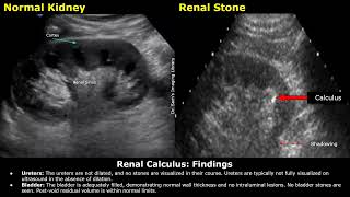 Renal Stone Kidney Ureter amp Bladder KUB Ultrasound Report Example  Renal Calculus USG Scan [upl. by Afinom618]