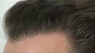 Haartransplantation Hattingen Hair Transplant  3089 FU´s [upl. by Wilton]