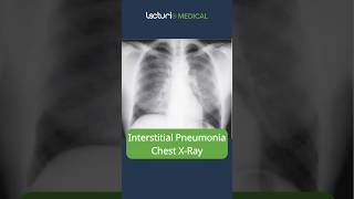 Understanding Interstitial Pneumonia 🫁 MedicalEducation usmle [upl. by Gallard]