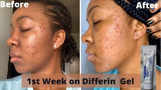 DIFFERIN GEL Review1st week update adapalene gel for acne and hyperpigmentation differingel [upl. by Monto360]