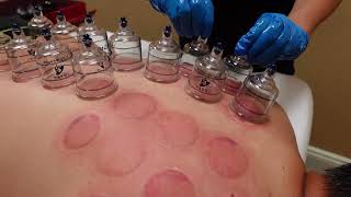 Cupping Therapy and Ayurvedic Head Massage  Improve Circulation and Reduce Tension [upl. by Rondi]