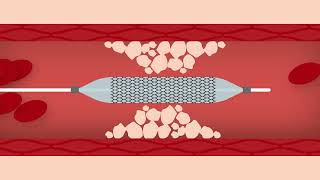 Heart Stent Procedure [upl. by Cleodell515]