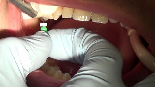 root canal treatment part 1 [upl. by Harilda]