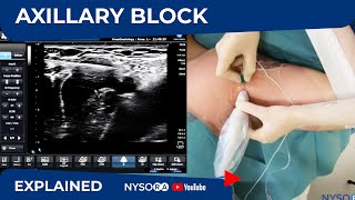 Ultrasound Guided Axillary Brachial Plexus Block NYSORA Regional Anesthesia [upl. by Llertac]