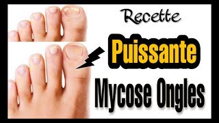 COMMENT JAI SOIGNÉ MA MYCOSE DES ONGLES DE PIED NATURELLEMENT Vie Saine [upl. by Lirrehs]