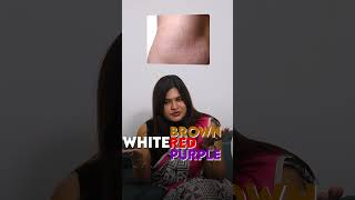 Can Stretch Marks Be Treated Here’s What You Need to Know  DrRadha Dermatology [upl. by Arihs]