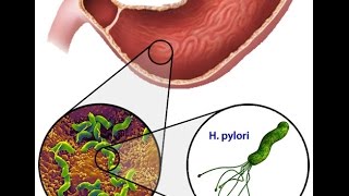 Helicobacter Pylori [upl. by Ahsela260]