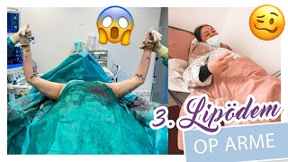 3 LIPÖDEM OPERATION  ARME  Erste VOLLNARKOSE Liposuktion Heilung Kosten etc  YooNessa [upl. by Mahgem]