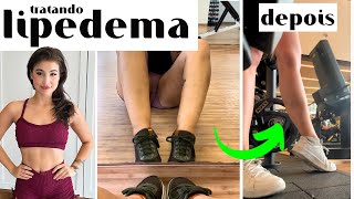 COMO IDENTIFICAR E TRATAR LIPEDEMA [upl. by Osborn400]