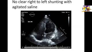 Rare form of Atrial Septal Defects and Review of ASDs [upl. by Atirac]