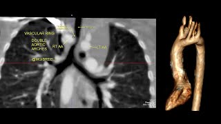 1 year child with stridor CT shows complete vascular ring  DAA  Double Aortic Arches [upl. by Ahsiemal]