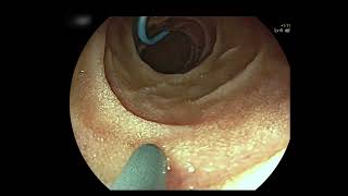 ERCP in Gastrojejunostomy bypass [upl. by Charlena]