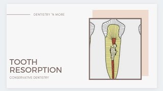 TOOTH RESORPTION [upl. by Doralynn]