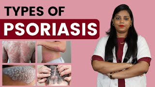 Main Types of Psoriasis  Explained in Detail by  Dr Kanchan Singh [upl. by Robena81]