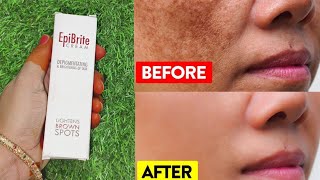 Epibrite cream depigmenting amp brightening of skin review [upl. by Allak72]