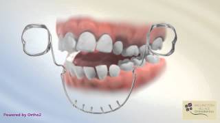 Lower Tongue Crib Appliance  Wellington Village Orthodontics [upl. by Older]