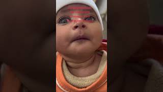 Laryngomalacia No Treatment Then Supraglottoplasty [upl. by Wylde]