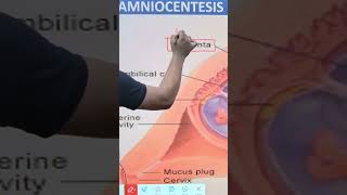 AMNIOCENTESIS  CLASS 12th BIOLOGY  NEET CBSE BOARD BY  Dr SHUBHAM SINGH IMS BHUshorts [upl. by Olmsted]