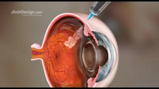 Intravitreal Injection Animation HD [upl. by Yesoj311]