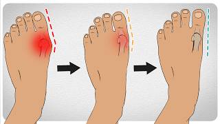 How to Fix Bunions in 5 Steps [upl. by Klement]