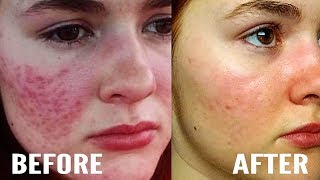 How I Cleared My Hyperpigmentation and Acne Marks At Home [upl. by Spence706]