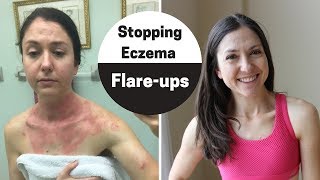 How to handle eczema flareup My 4 step checklist to clear skin [upl. by Ahsikat]