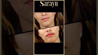 Achieve Perfectly Balanced Lips with Lip Fillers  Sarayu Clinics fillers [upl. by Fritts]