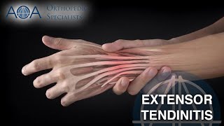 AOA Orthopedic Specialists  Extensor Tendinitis [upl. by Eillat]