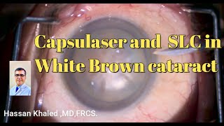 Capsulaser SLC amp White Brown Cataract [upl. by Hannus]