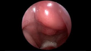 Nasopharyngeal Carcinoma NPC Endoscopic View of Nasopharynx Versus Normal [upl. by Borreri]